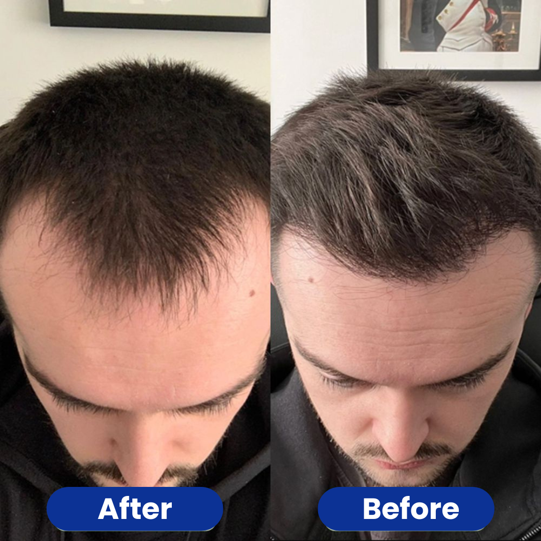 Capilène™ - Hair Growth Serum