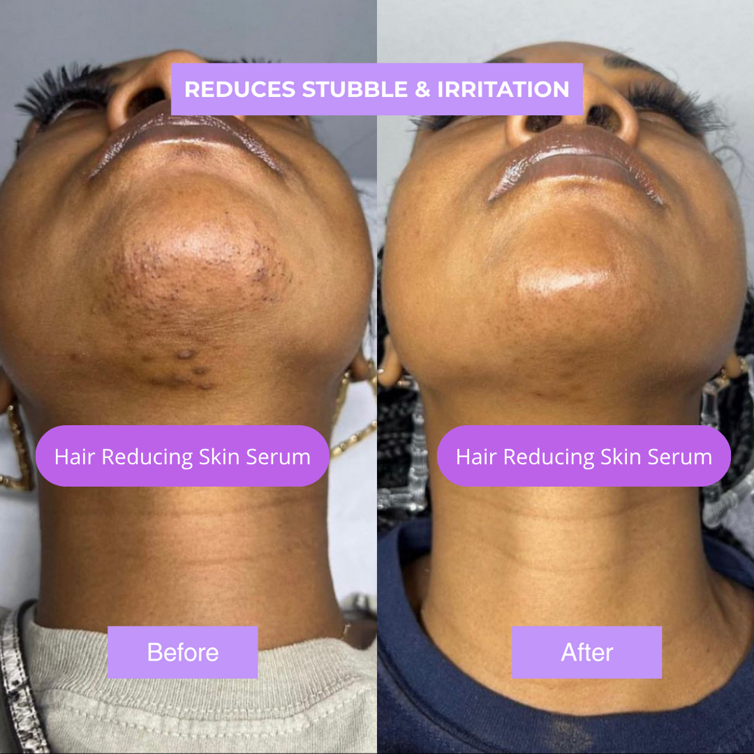 New Facial Hair Reducer Serum